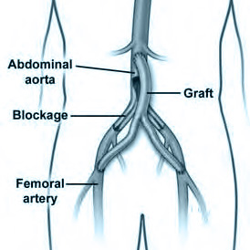 Aorto-Femoral Graft.indd | Dr Matley & Partners