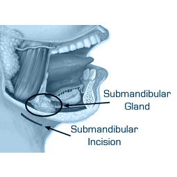 Submandibular-Gland-Excision-5 | Dr Matley & Partners