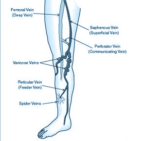 Varicose-Veins-Operation-5 | Dr Matley & Partners