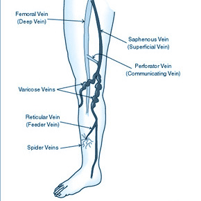 Varicose-Veins-Radio-Laser-5 | Dr Matley & Partners